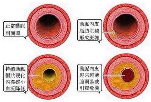 TG偏高是什么_TG偏高是什么原因